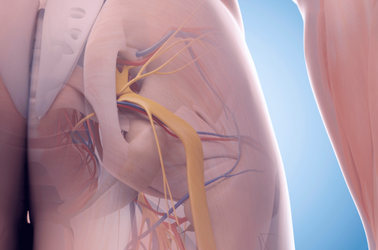 Scıatıc Nerve Compressıon Treatment